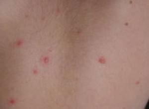 Дети заболели ветрянкой