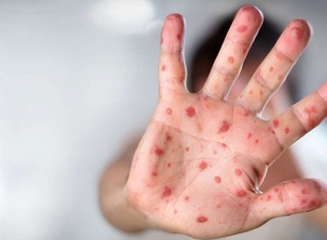 Հունիսի 10-ի դրությամբ հանրապետությունում գրանցվել է կարմրուկով վարակման 452 դեպք