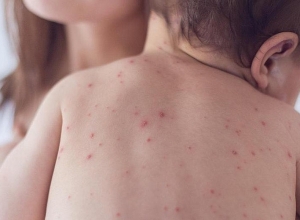 Более 140000 человек умерли из-за вспышек кори