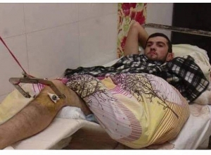 В Арцахе оказывают медицинскую помощь азербайджанскому военнопленному: его прооперировали