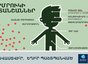 В Республике Армения зарегистрировано 11 лабораторно подтвержденных случаев кори