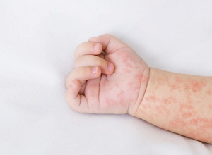 Ребёнок в возрасте 1 год и 8 месяцев умер от кори