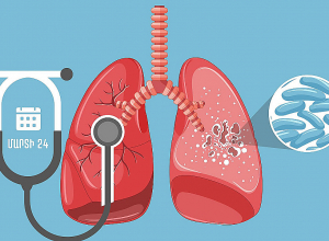 Այսօր Տուբերկուլոզի դեմ պայքարի համաշխարհային օրն է