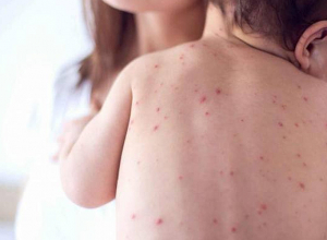 Հայաստանում կարմրուկի լաբորատոր հաստատված դեպքերի թիվը հասել է 362-ի՝ մեկ շաբաթում ավելանալով 20-ով