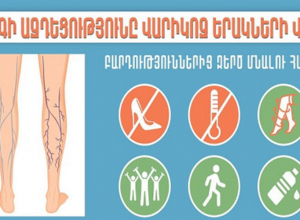 Շոգը վարիկոզի առաջացման պատճառ չէ, բայց եթե հիվանդությունն արդեն առկա է, շոգը կարող է խորացնել վարիկոզով պայմանավորված հիվանդության ախտանիշները