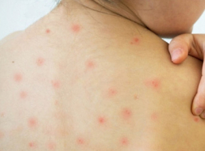 Առաջին անգամ ներդրվել է ջրծաղիկի դեմ պատվաստումը