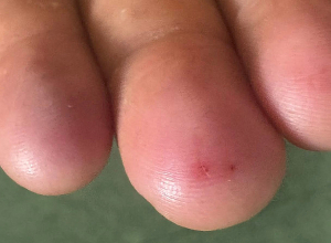 Սպիտակում օձի խայթոցով 2 երեխա է հիվանդանոց տեղափոխվել